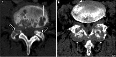 The Frequency of Axial Deposition in Korean Patients With Gout at a Tertiary Spine Center